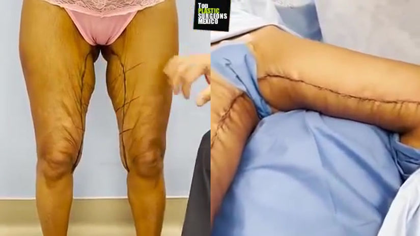 MEDIAL THIGH LIFT (extended incision)